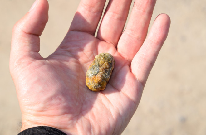 Gallstone - Shutterstock