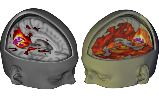 Brain on LSD - Beckley Foundation