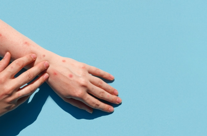 Monkeypox new disease dangerous over the world. Patient with Monkey Pox. Painful rash, red spots blisters on the hand. Close up rash, human hands with Health problem. Banner, copy space. Dengue fever